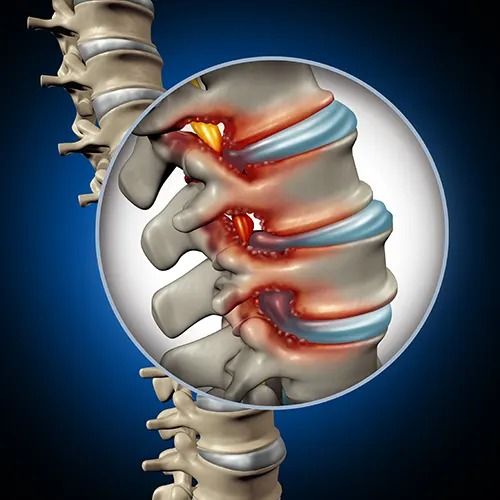 Disc bulge treatment image for spine physiotherapy